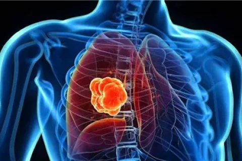 荷兰科研新突破：电子鼻可迅速识别适用肺癌免疫疗法的患者