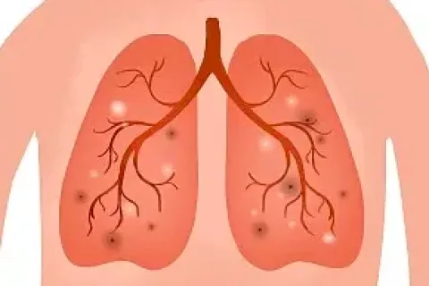 转移性肺癌患者体内抗肿瘤免疫应答首次被激发
