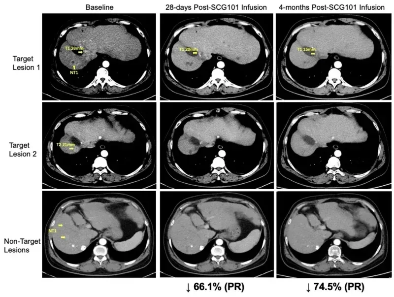 全球首创TCRT细胞疗法引爆2025 ESMO大会，首次人体试验100%控瘤，实体瘤新刃斩落肺癌、肝癌、肠癌等