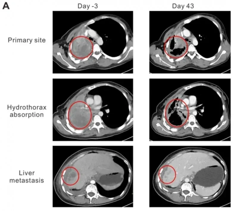 全球首创TCRT细胞疗法引爆2025 ESMO大会，首次人体试验100%控瘤，实体瘤新刃斩落肺癌、肝癌、肠癌等
