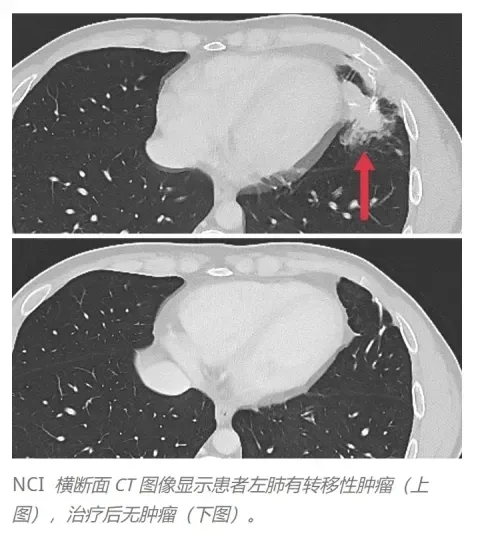 全球首创TCRT细胞疗法引爆2025 ESMO大会，首次人体试验100%控瘤，实体瘤新刃斩落肺癌、肝癌、肠癌等