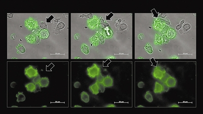“血癌细胞之吻”让免疫细胞沉睡