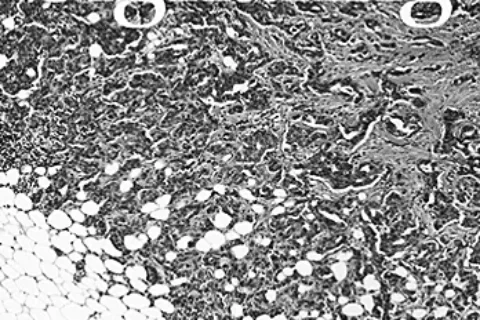 阿司匹林除抗炎之外 还可消除肿瘤干细胞