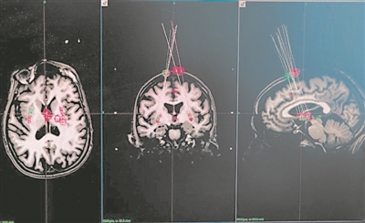 干细胞疗法或将翻开新篇章