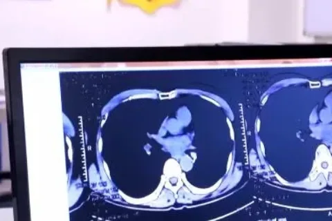 我国恶性肿瘤五年生存率升至40.5%