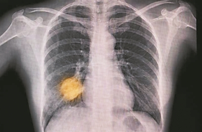 2024年有望改变医学的11个临床试验