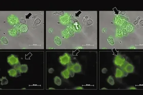 “血癌细胞之吻”让免疫细胞沉睡